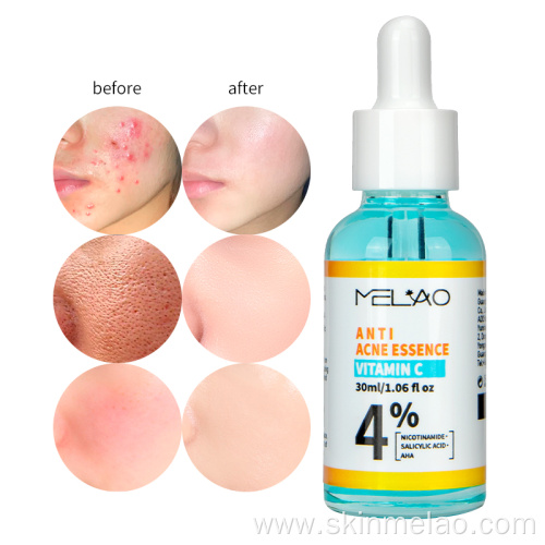 Anti Acne treatment Pimple Remover Serum